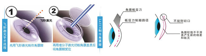 飞秒激光近视矫治手术